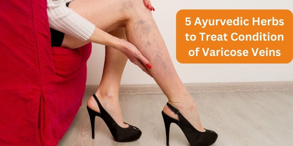 Varicose Veins ayurvedic treatment in hadapsar