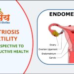 Endometriosis & Fertility