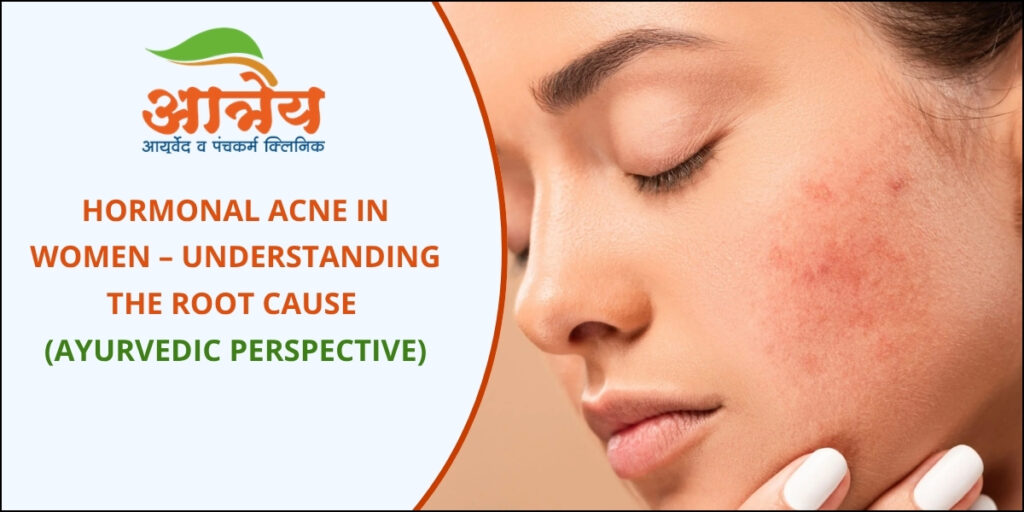 Hormonal Acne in Women (Ayurvedic Treatment)