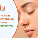 Hormonal Acne in Women (Ayurvedic Treatment)